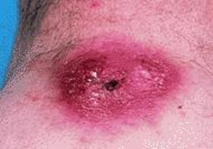 “*品毒**”引起的皮肤病变，触目惊心！