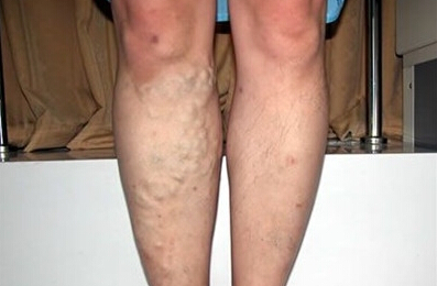 下肢静脉曲张中医方剂,中医认为下肢静脉曲张的根源何在