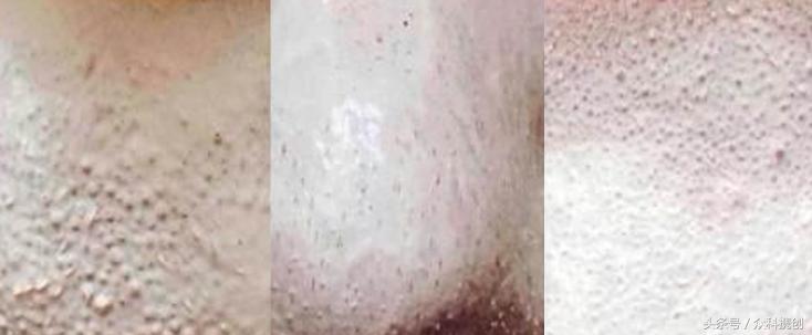 火山泥真的能清洁毛孔吗,用火山泥洗脸再用洗面奶