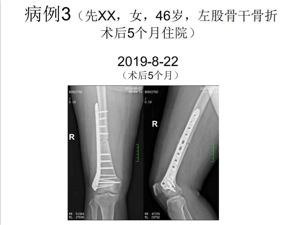 平乐骨科推拿教学,中医治疗骨折畸形愈合