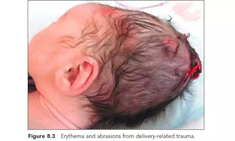 新生儿皮肤问题大全一览表,新生儿常见八大皮肤问题