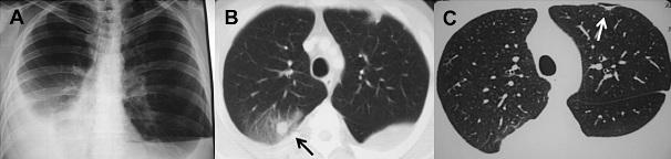 类风湿患者身上起一片疙瘩,类风湿关节有小疙瘩