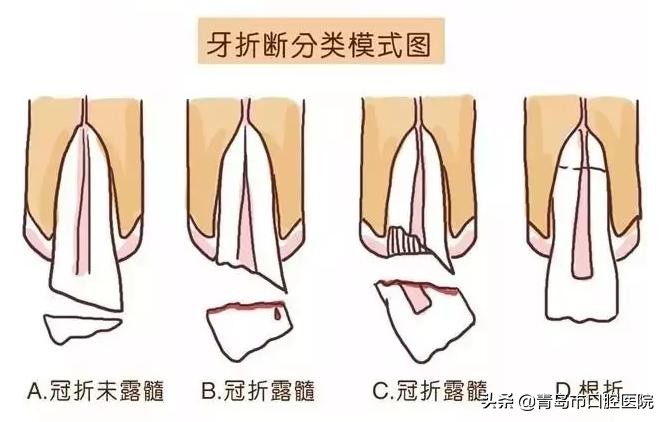 小孩摔断了乳牙需要拔掉吗,换过牙以后儿童摔断牙齿怎么处理
