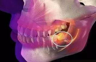 牙龈肿痛是怎么回事吃什么消炎药,牙龈肿痛是怀孕的征兆吗