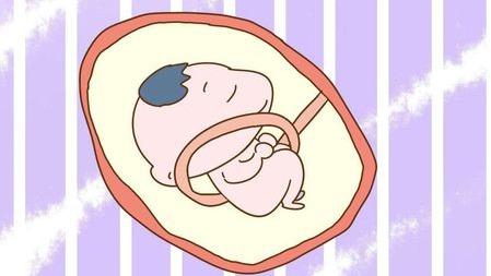 脐带绕颈二圈怎么纠正,脐带绕颈是什么造成的