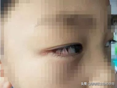 儿童游泳后头疼是怎么回事,儿童游泳眼睛发炎怎么办