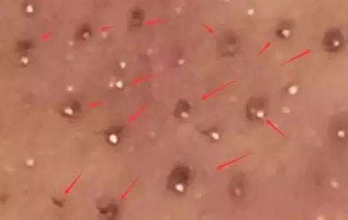 挤黑头和吸黑头哪个对毛孔损伤大,改掉挤黑头的习惯黑头会有改善吗