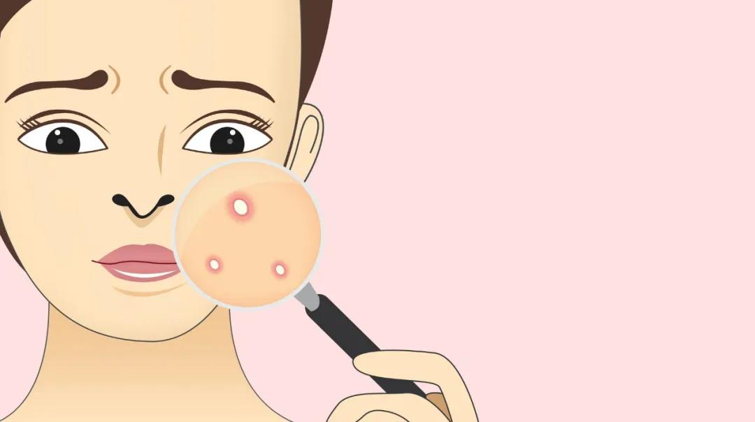 如何祛痘印,如何祛痘印男生