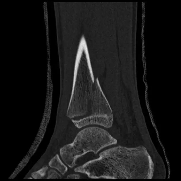 所有骨折都叫什么名字,骨折的名称有哪些