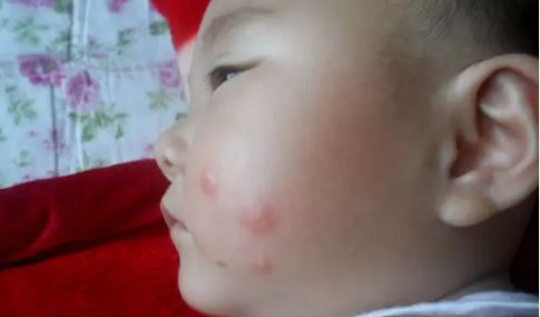 普及!宝宝湿疹不敢用药怕激素?湿疹护理指南来帮你