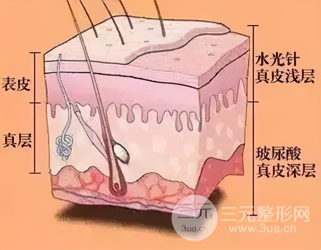 祛痘一般用什么医美,痘肌可以做祛痘医美项目