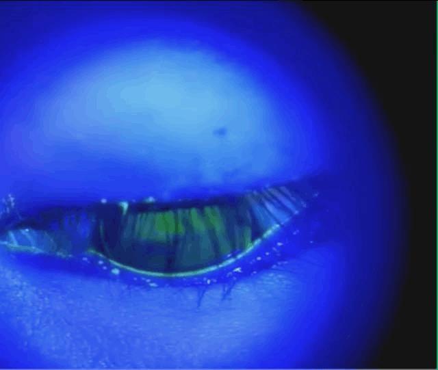 孩子眼睛近视加散光如何治疗,儿童视力散光180度怎么办