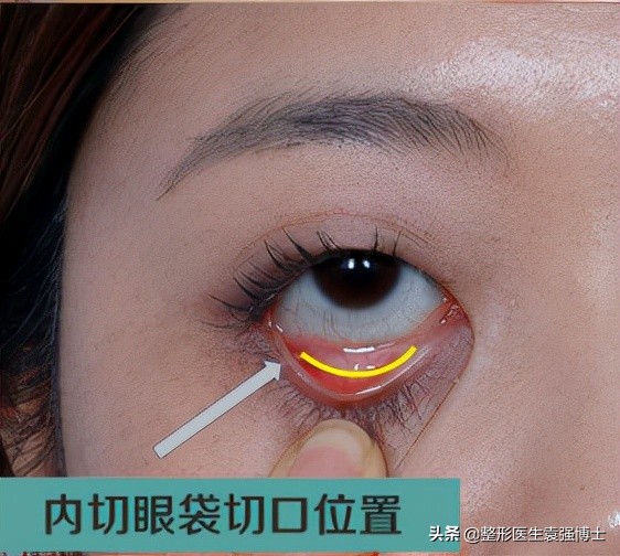 做眼袋都需要问医生什么问题,做手术前要咨询医生哪些问题