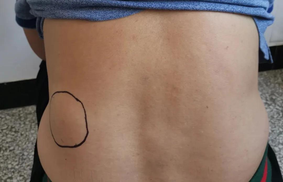 腹股沟疝有几种类型如何鉴别,腹股沟疝有哪些特点