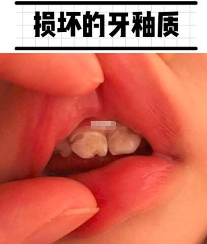 保护牙釉质的有效方法,医生建议如何护理牙齿