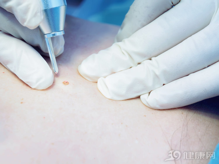 色素痣切除后如何祛疤,手术祛色素痣后疤痕明显吗