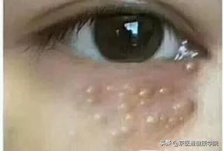 粟丘疹与汗管瘤脂肪粒去除小妙招,粟粒疹扁平疣