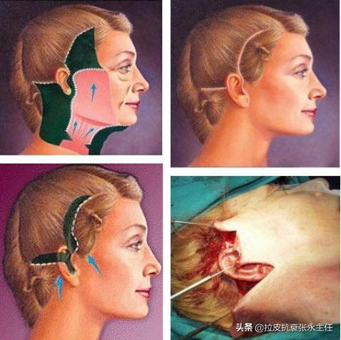 小切口拉皮手术可以维持多久,哪些人适合拉皮除皱术