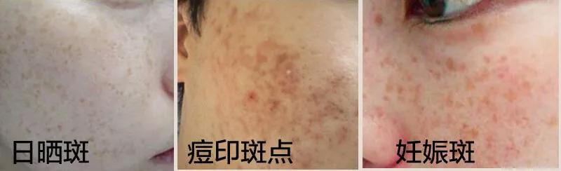 祛脸上斑点色斑的小妙招,一个动作教你如何淡化色斑