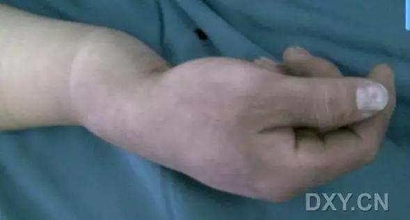 特殊骨折类型,特殊骨折体征