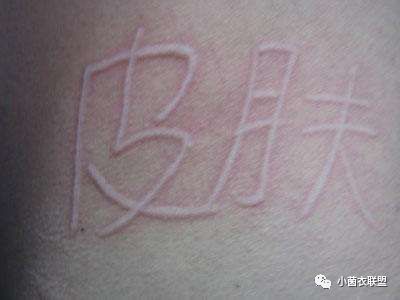 瘙痒性麻疹,如何快速解决荨麻疹的瘙痒问题