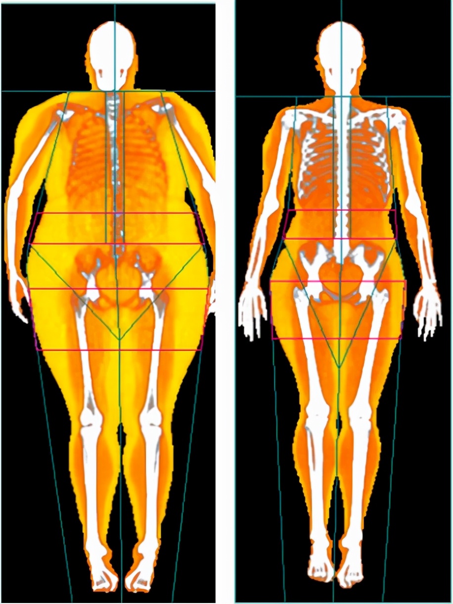 糖尿病消耗的是脂肪还是肌肉,糖尿病如何调养肝脏和胰腺