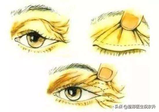 当你老了，上眼皮松了，其实恢复年轻并不难...