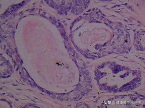 外阴良性肿瘤的症状,外阴良性肿瘤暂时不做手术可以吗