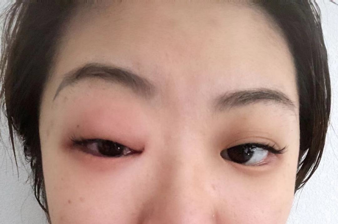 中医治疗眼部皮肤过敏,眼部红肿痒中医治疗