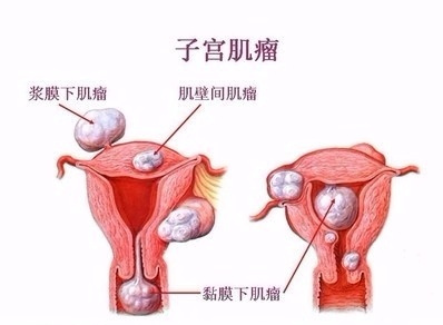 子宫肌瘤有病变,如果得了子宫肌瘤会有什么反应