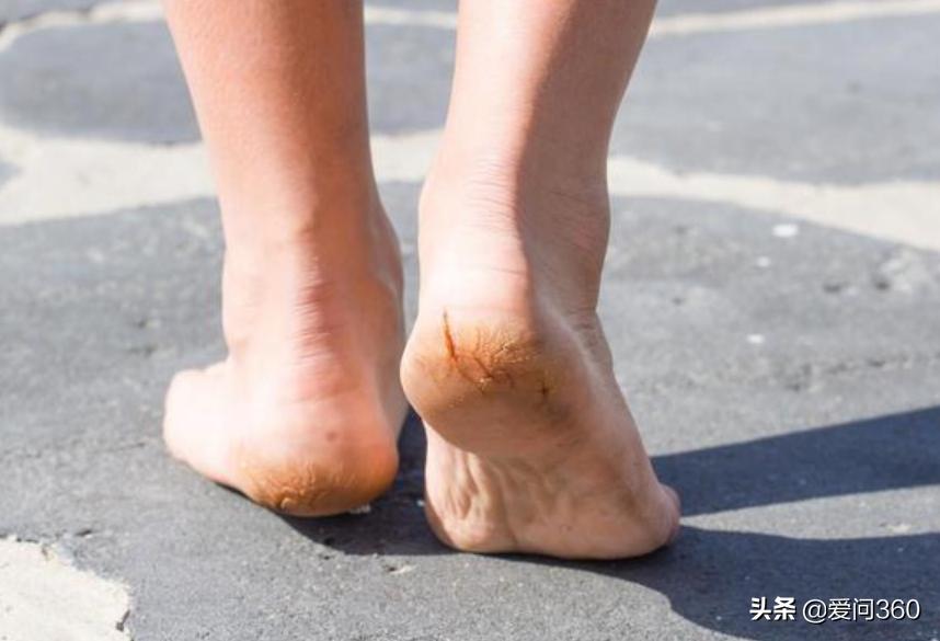 中老年人脚后跟开裂，大多是这些原因造成的，5个方法可改善