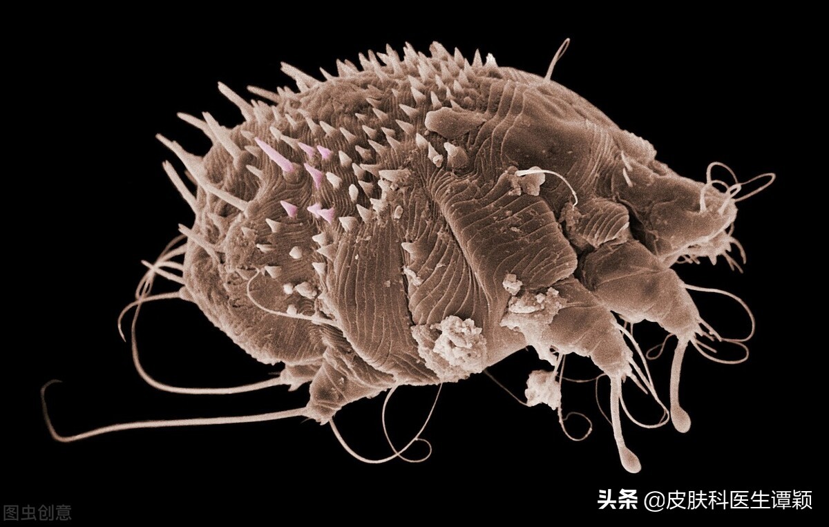 医生讲疥疮如何治疗,皮肤科疥疮的正确治疗