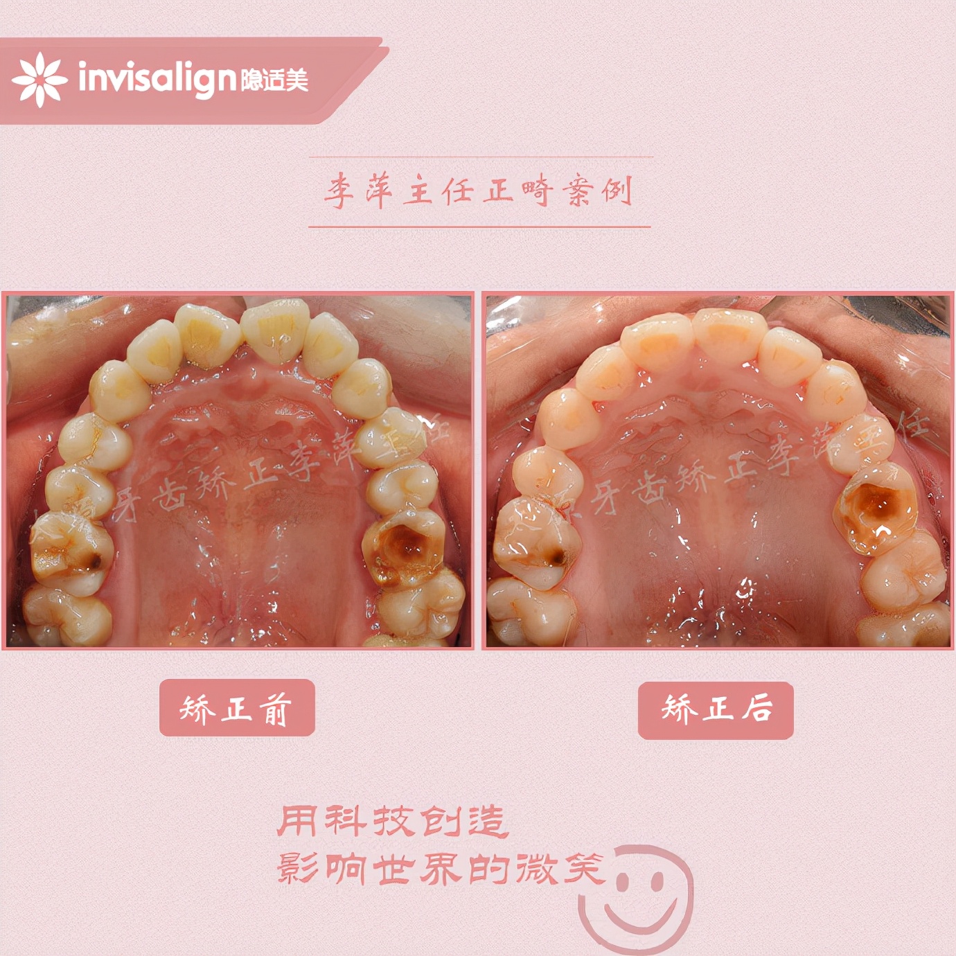 成都牙齿有缝隙怎么矫正,牙齿拥挤矫正前两天不痛正常吗