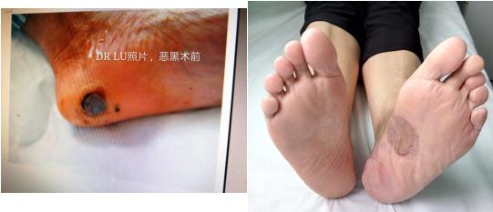 无精症患者的新希望,卵巢癌最新治疗新希望