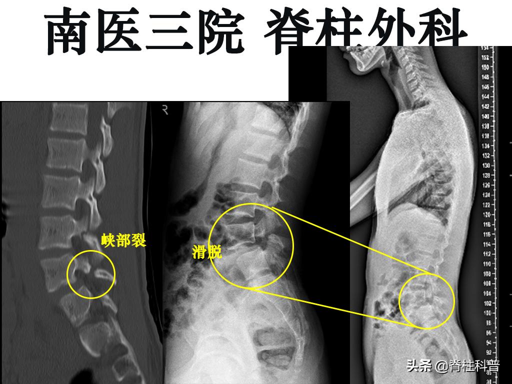 峡部裂导致滑脱有没有痊愈的可能,青少年峡部裂做哪种手术最好