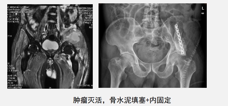 深入骨髓的痛!30年前不能治的骨转移,现在或有3个机会