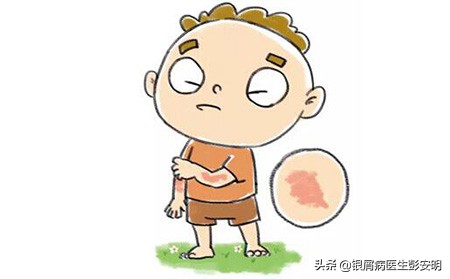 凡士林西瓜霜治白癫风,银屑病西瓜霜和凡士林