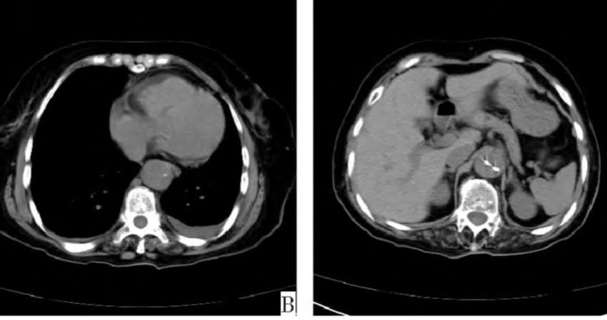 如何监测动脉夹层早期,动脉增强ct能查出主动脉夹层么