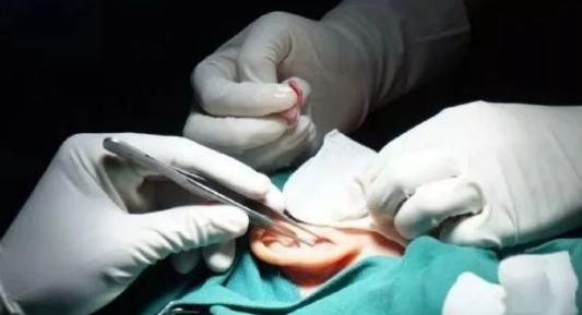 隆鼻方法,隆鼻比较好的方法