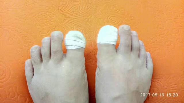 甲沟炎经验分享,甲沟炎的自愈经历