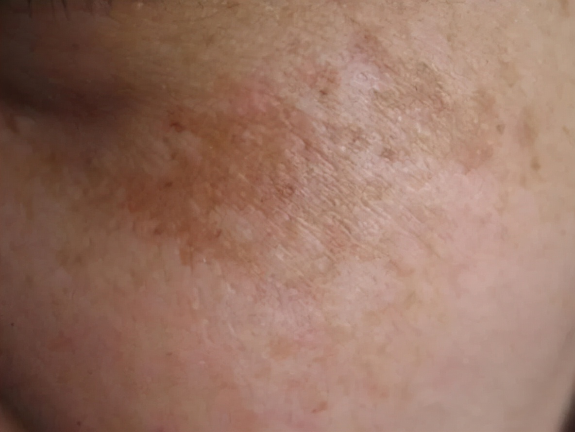 欧阳医生带你了解*褐斑黄**的成因及预防