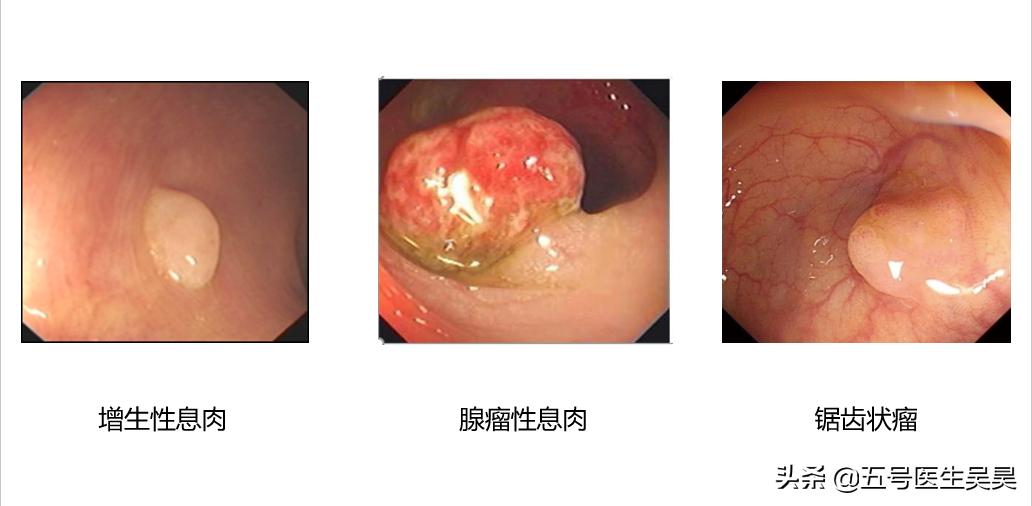 关于“大肠息肉”的6个问题，搞清楚再去检查也不迟