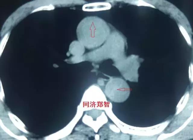 磁共振可以替代cta检查主动脉夹层,超声心动图联合cta诊断主动脉夹层