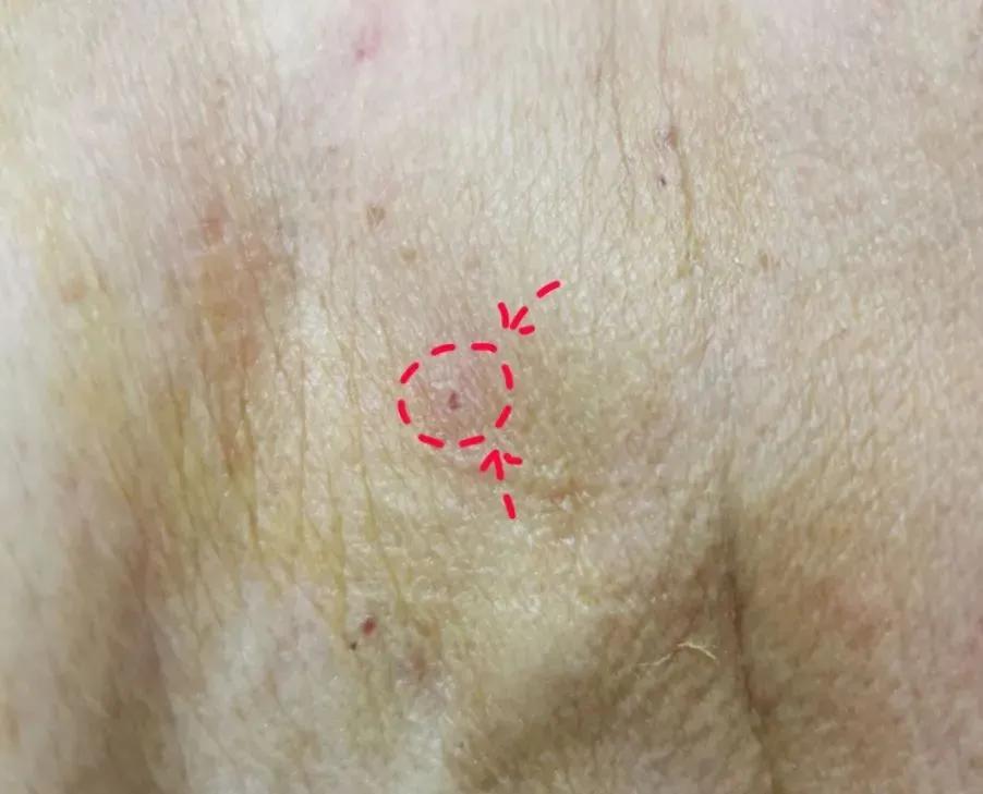 甲状腺囊肿介入,甲状腺囊肿介入治疗效果如何