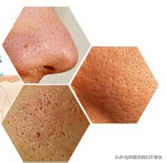 油性痘痘肌可以用白醋洗脸吗,白醋洗脸对脸毛孔有好处吗