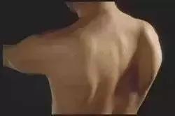 蝴蝶骨最好的矫正方法,蝴蝶骨是不良体态吗