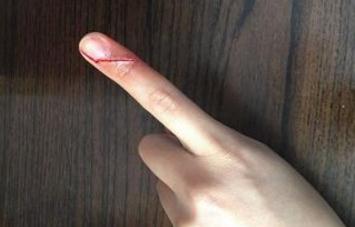 甘油三酯高会引起皮肤发黑吗,甘油三酯高流血后出的血偏白色