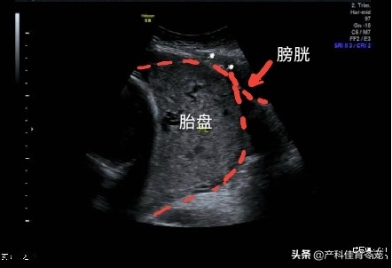 剖宫产术后并发症切口憩室,剖宫产发现胎盘植入怎么办