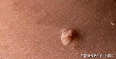 身上长个小肉球用头发能拔掉吗,皮肤上长小肉球