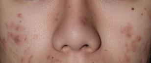 祛痘不再走弯路,祛痘体验苗医生